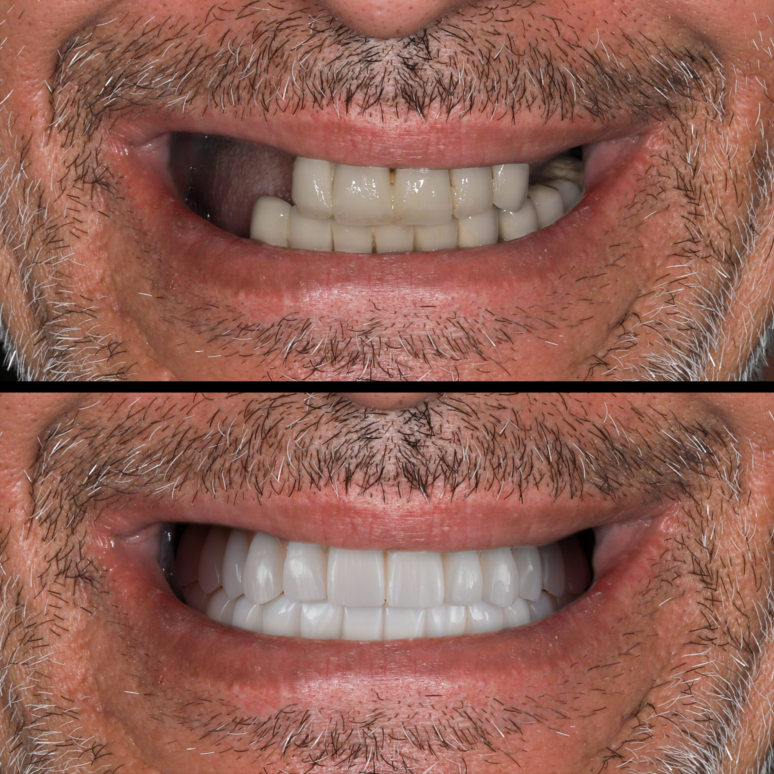 Full-arch dental prosthesis with the All on Four and All on X treatment concept for edentulous jaws in dental implant treatment. Dental X ray image and dental before and after smile design.